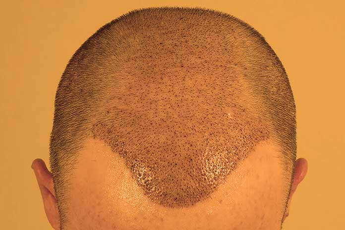 What To Do After A Hair Transplant