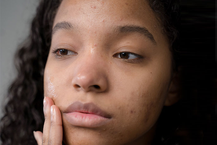 Diet For Acne