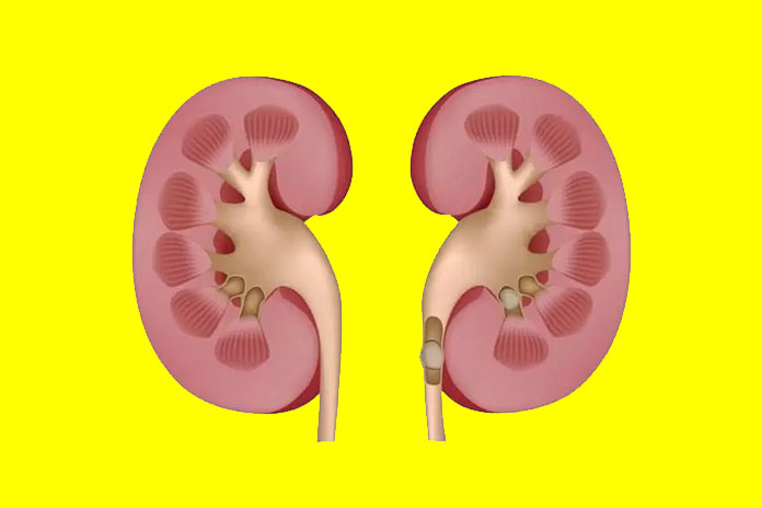 What To Eat Renal Colic And What Is Best To Avoid